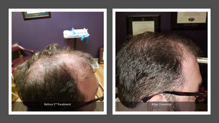 PDOScalpthreading  INNOVATIVE SOLUTIONS FOR HAIR LOSS